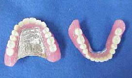 金属床義歯の写真