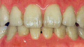 ホワイトニング治療前。歯の色がくすんでいます。