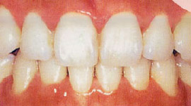 ホワイトニング治療後。歯の色が真っ白に美しくなりました。